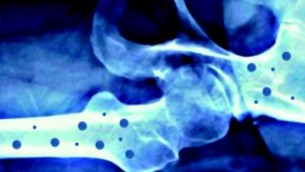 Il 20 ottobre 'Giornata mondiale dell’osteoporosi'