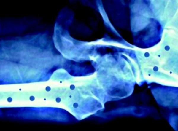 Il 20 ottobre 'Giornata mondiale dell’osteoporosi'