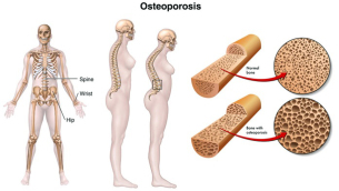 osteoporosi2