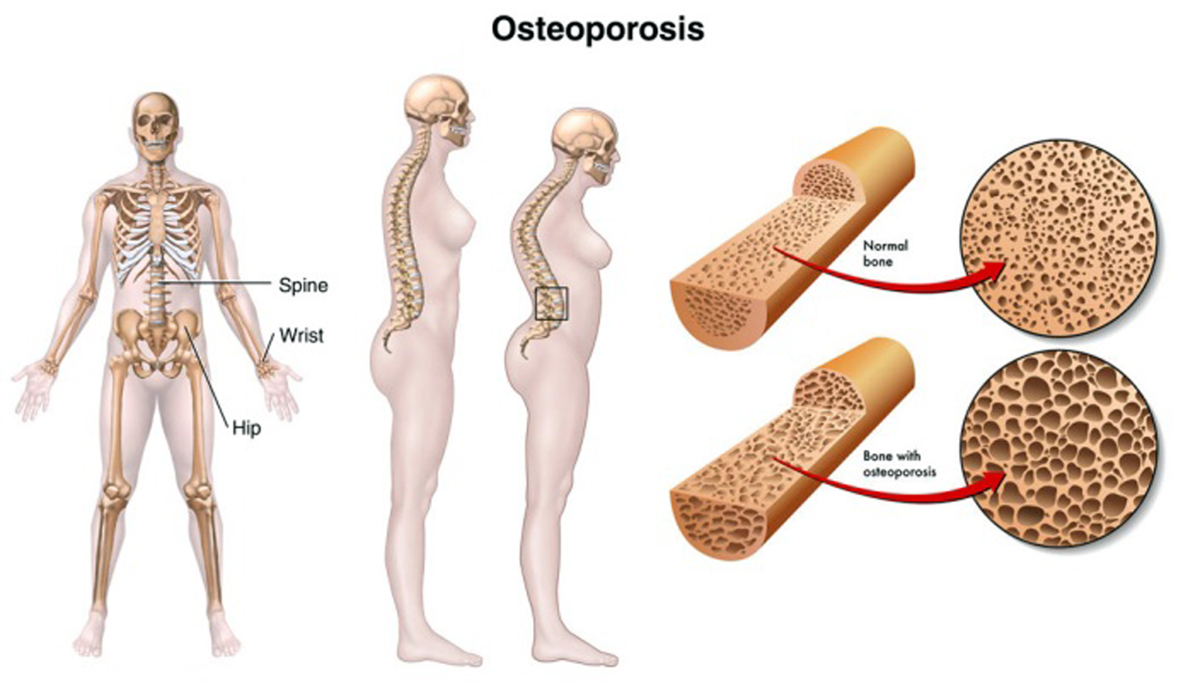 osteoporosi2