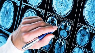 Scoperto meccanismo chiave dell'Alzheimer: speranza per diagnosi e cure